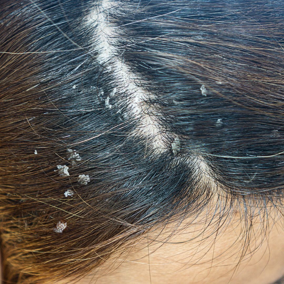 Scalp Psoriasis Treatment – Grey Gone